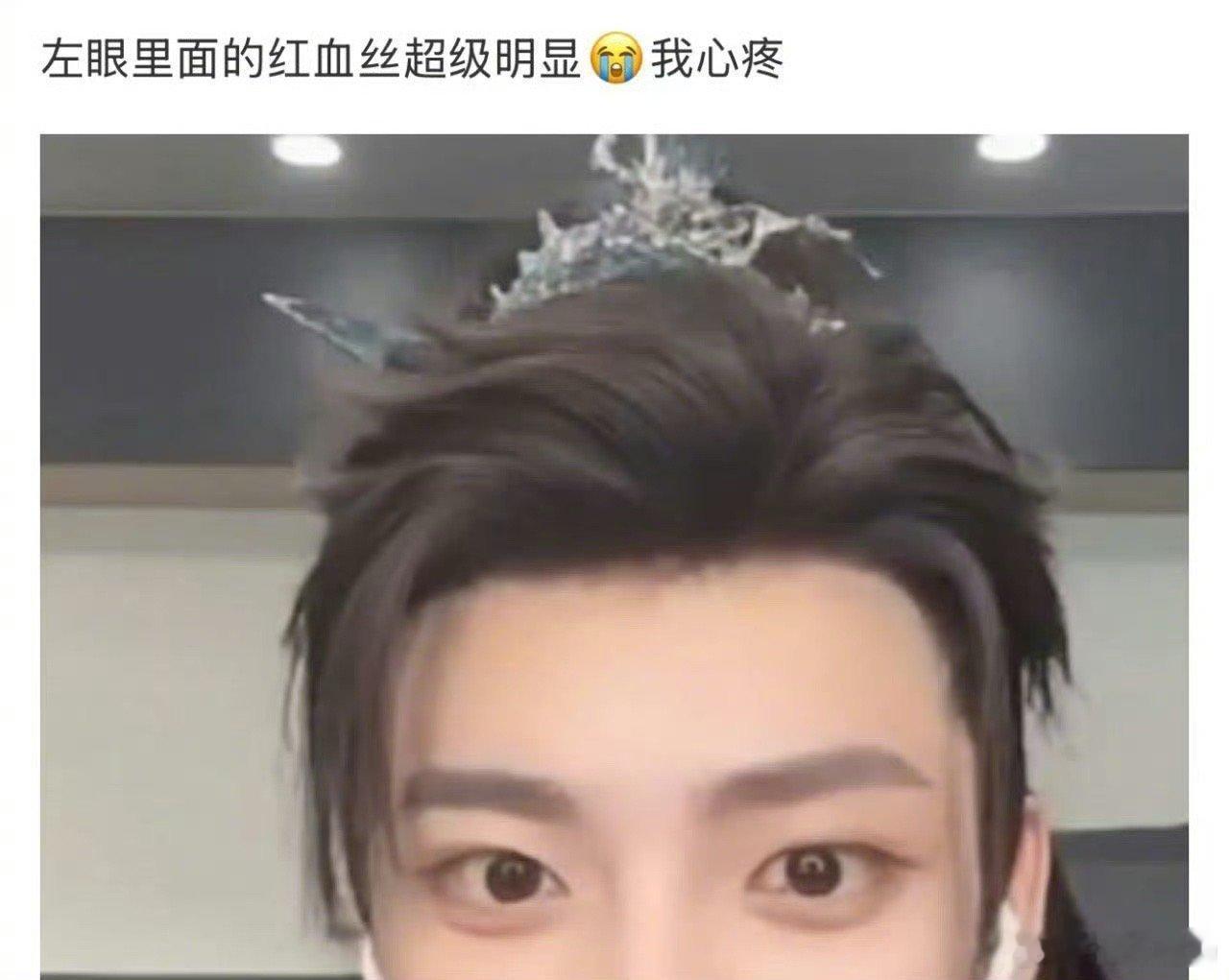#侯明昊眼睛怎么了#好心疼呀[泪][泪][泪]工作的同时也一定要照顾好自己的身 