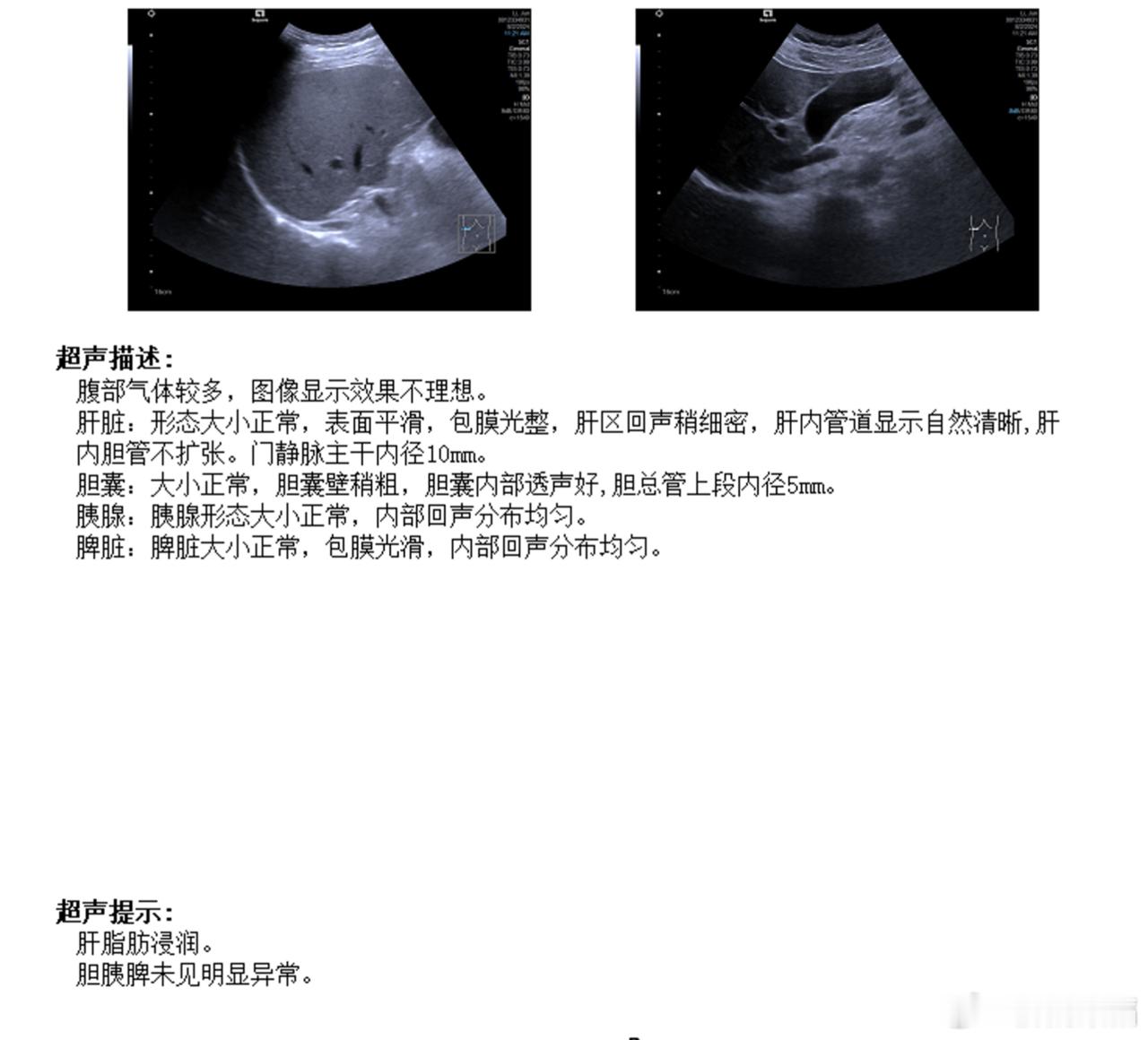 肝脂肪浸润，就是脂肪肝。这是一种描述性诊断。 ​​​