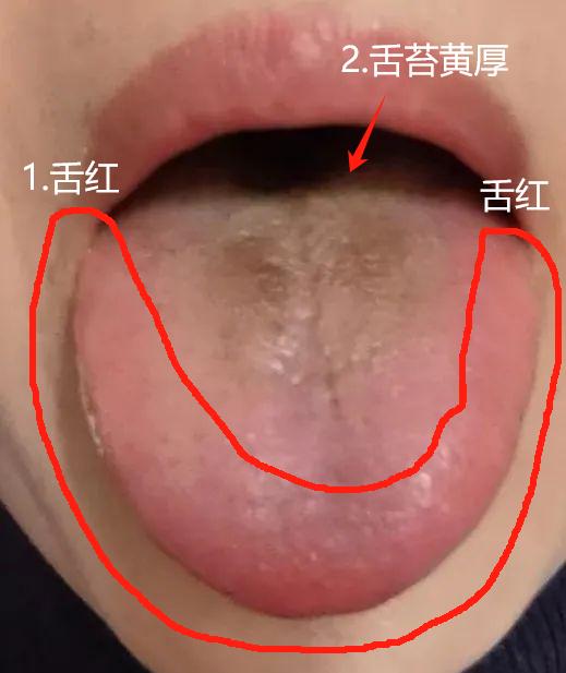 高血脂是一个常见的老年病，但很多中医的调养思路也不同，也就是不同的病因，采用的方