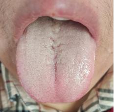 遇到这种舌头，你浑身没劲就对了！今天继续公益舌诊
 
遇到这种舌头，你浑身没劲就