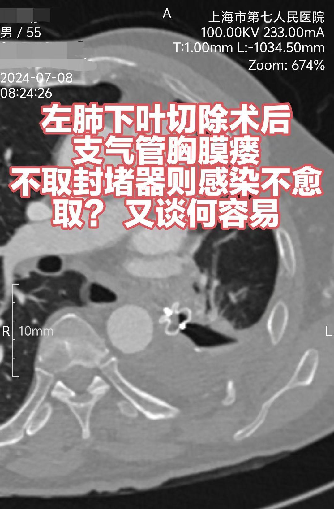 全国病友抱着期望来上海七院，挑战越来越大，瘘口更深，修补更艰难。昨日奋...