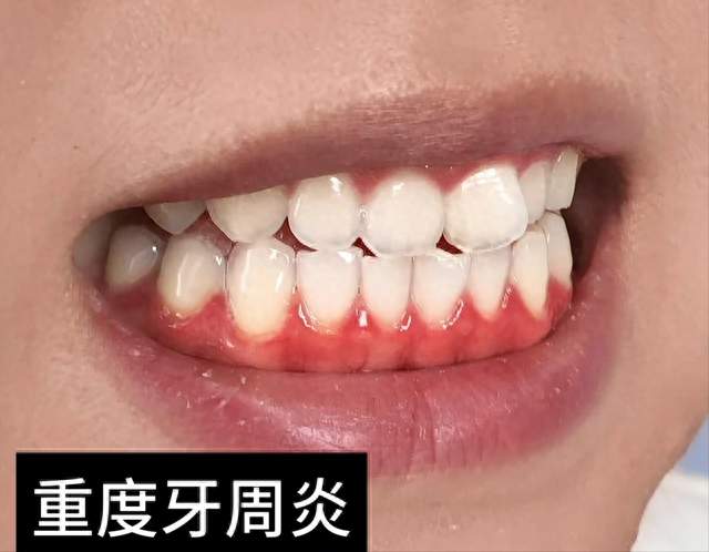 十几年牙周炎没往坏里走，睡前这个习惯帮了我