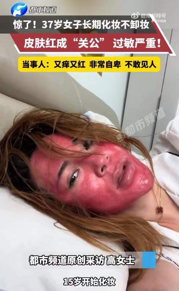 女子22年化妆不卸妆脸红成关公这和常年不摘隐形眼镜的人没啥区别[挖鼻]都是自己害