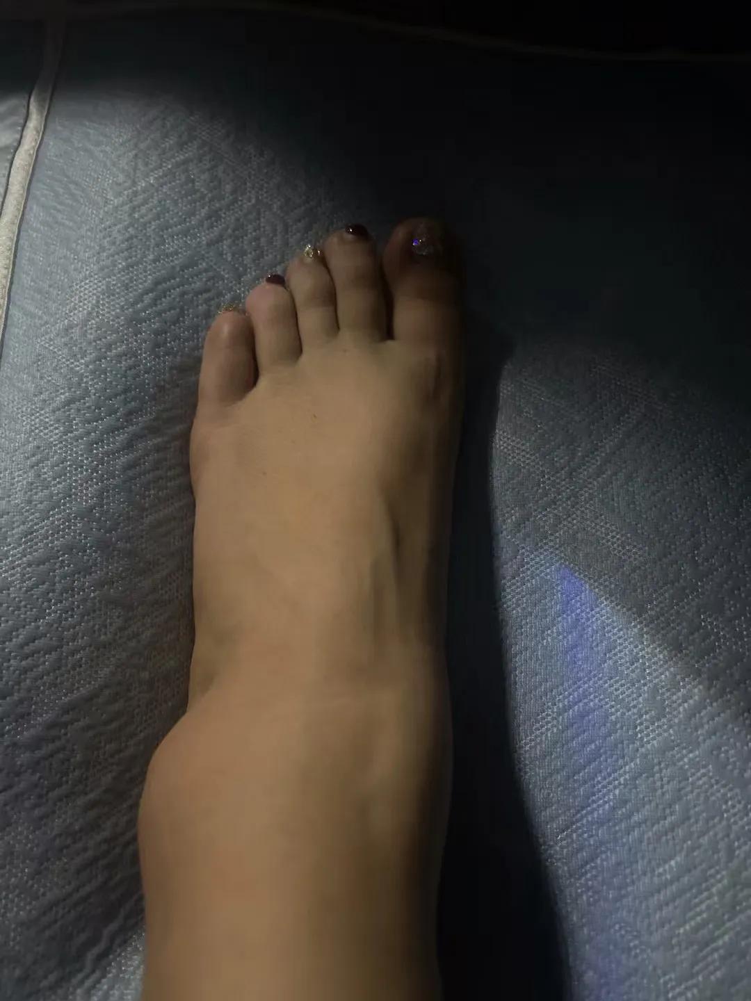 这次换了个脚，换左脚崴成这个猪蹄子样！我的脚是得罪哪路大神了？[捂脸][捂脸][