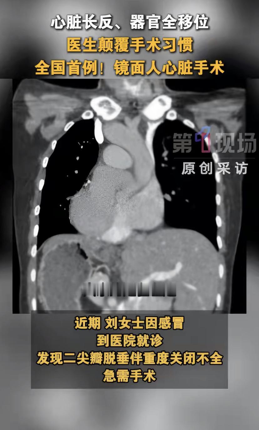 深圳有位39岁的李女士，心脏天生就"长反"了，还是个极其罕见的"镜面人"心在右边