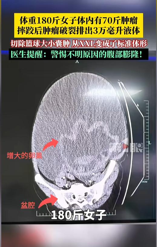“离大谱！” 浙江女子减肥多年，180 斤体重纹丝不动，没想到摔了一跤后，肚子突