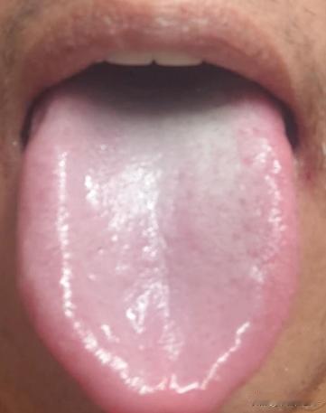 这样的舌头，还在吃参苓白术丸、归脾丸健脾吗？当务之急是疏肝！
病人主诉：胃口不好