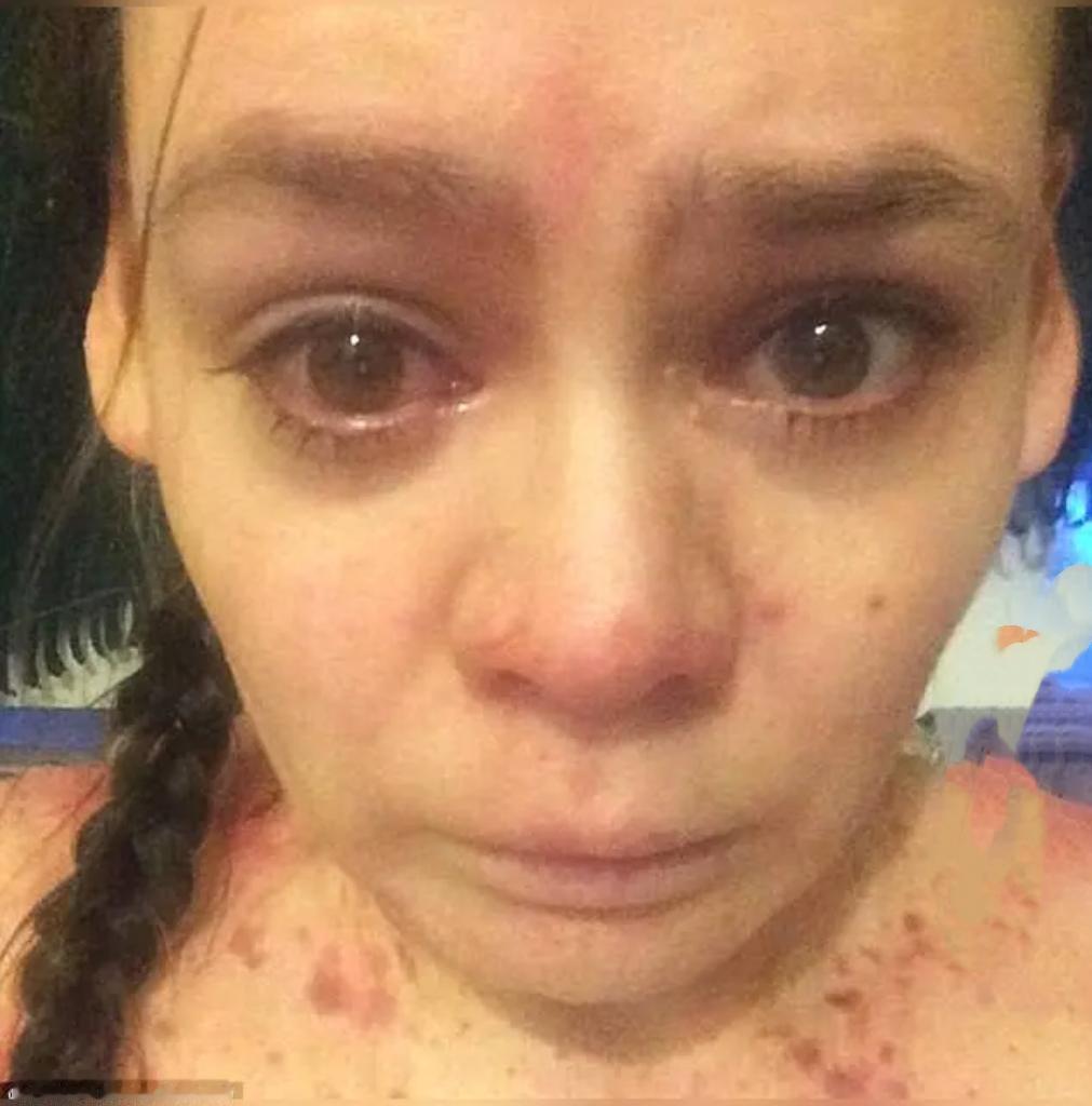 2026年2月，浙江一女子因皮肤反复瘙痒就医，检查发现竟与常年吃面食有关。医生称