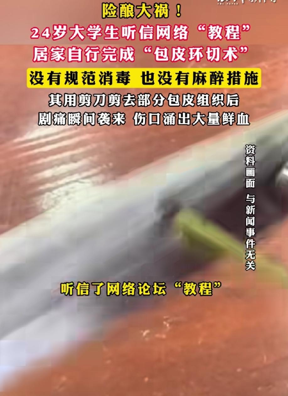 真是让人哭笑不得！
24岁大学生听信了网络论坛“教程”，自己在家完成“包皮环切术