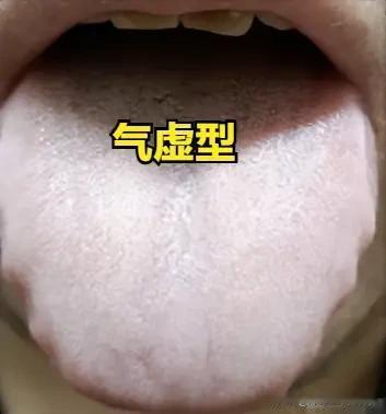 气虚型“有心无力”：补元气、固根本，才能恢复身体底气
 
大家好，我是陈大夫！