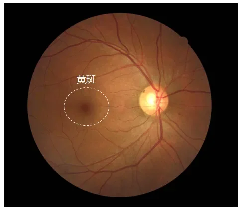 老年人视力头号杀手——黄斑变性