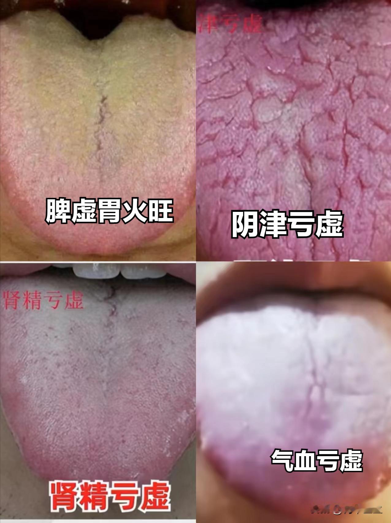 舌中有裂纹，别不当回事，早发现早治疗

1. 脾虚胃火旺
舌象：舌红苔黄，舌中为