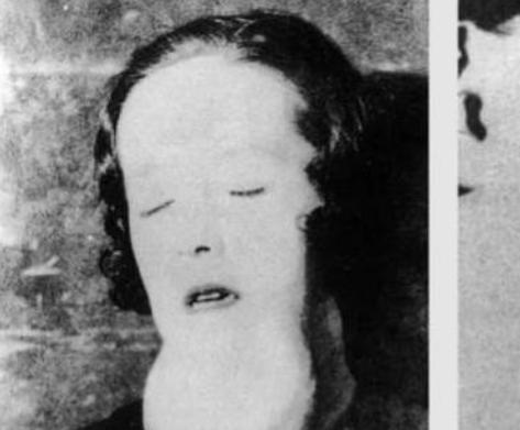 1922年，一名25岁的少女因为牙疼去看病当医生轻轻的触碰牙齿时，她的下颚骨却像