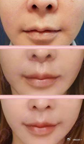 人中缩短+人中窝+嘴角上扬这三个项目放在一起做，出来的效果一般不会很“炸”，但会