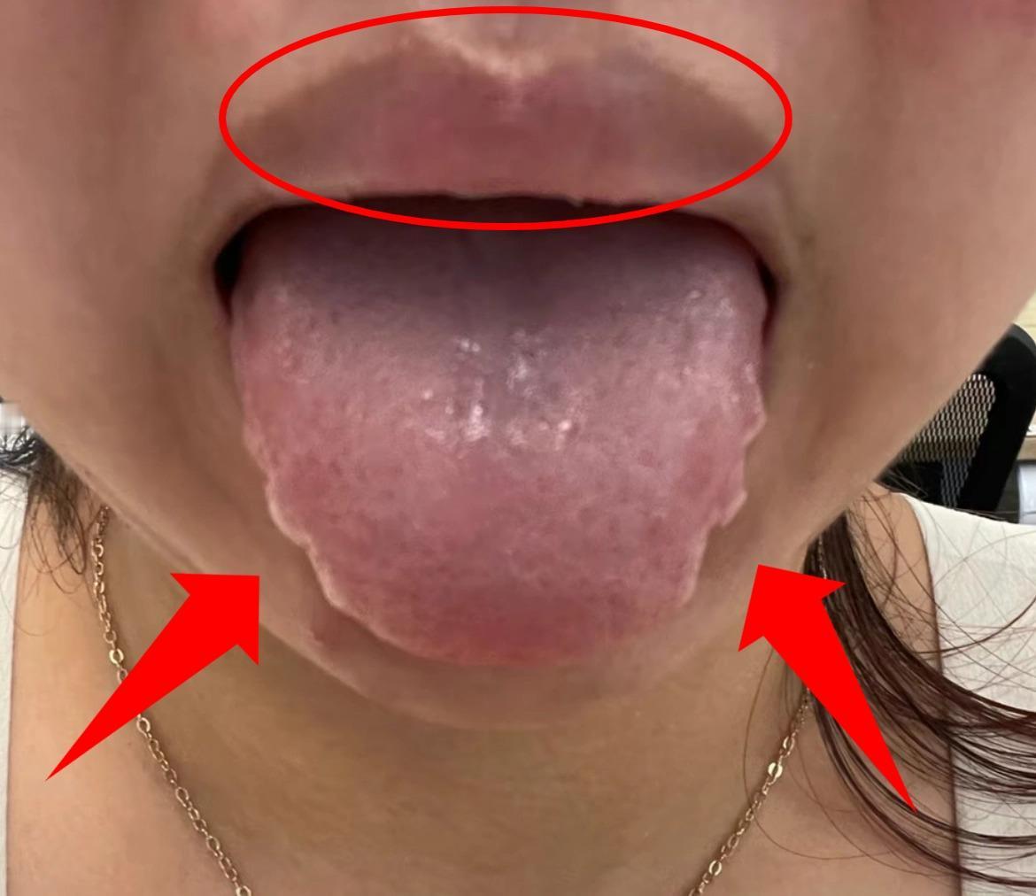 我真的有话说！齿痕深，嘴唇暗，眼睛无光呆滞
患者自述：进入4月份，身体很疲惫，食