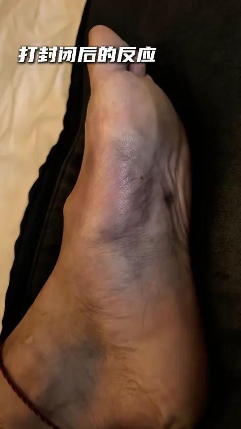 打封闭的男人＋1！
广厦晋级总决赛，孙铭徽赛后晒视频，打完封闭以后，整个脚骨都肿