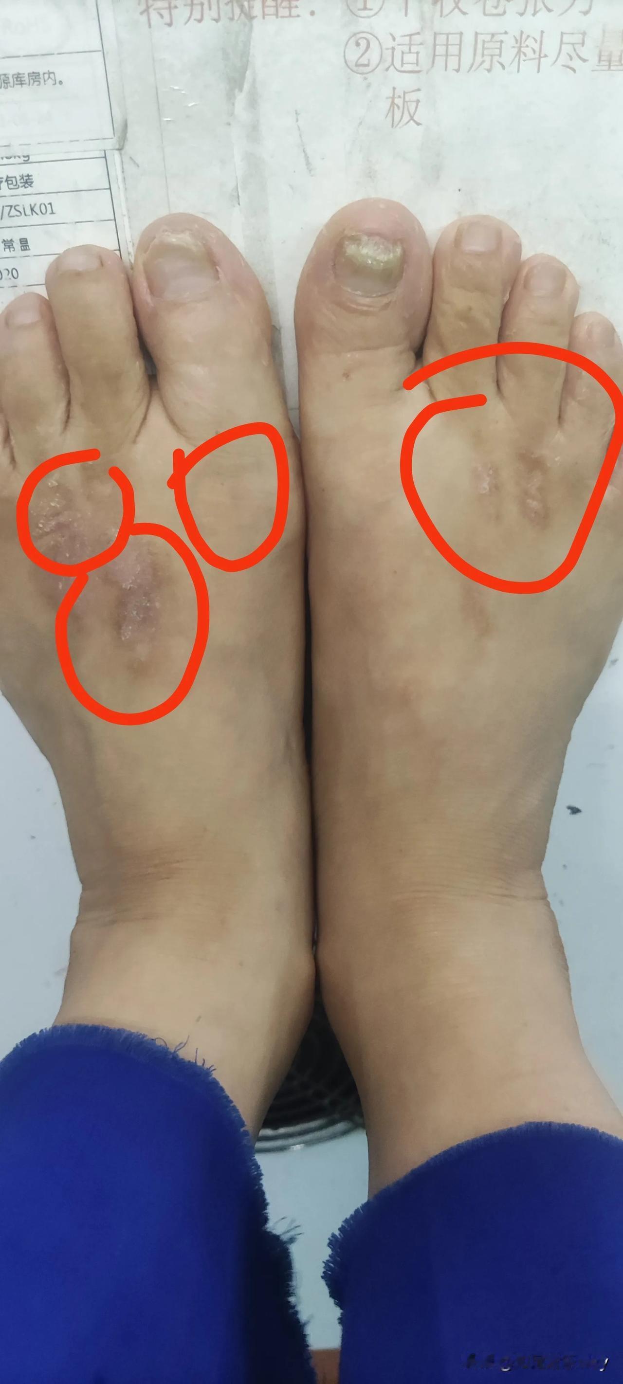 万能的网友们，我脚上有个痕迹，也不清楚是什么东西。有时候痒起来，那真叫钻心的痒，