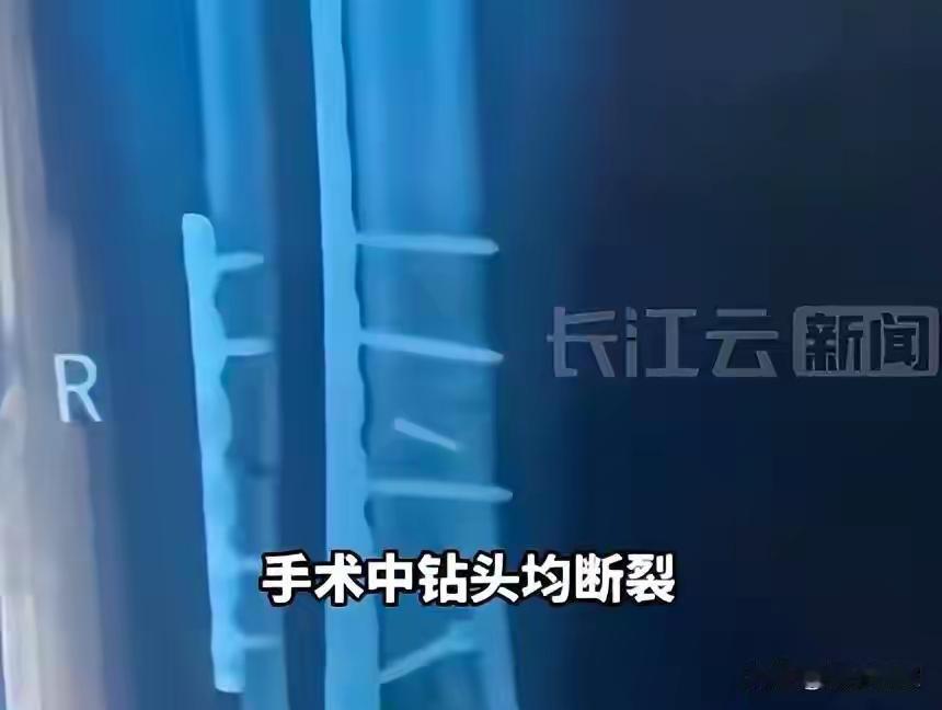 医院的这种说法真的是滑天下之大稽。
将钻头遗落在患者体内，居然轻描淡写地认为“影