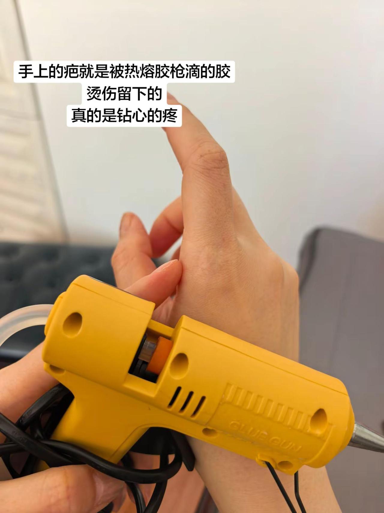 我手上这道疤啊，就是被热熔胶枪烫的！当时那钻心的疼，到现在都忘不掉……我一个大人