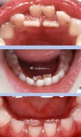 乳牙滞留：孩子的“双排牙”到底要不要拔？换牙期家长常常会发现一个问题：孩子的恒牙