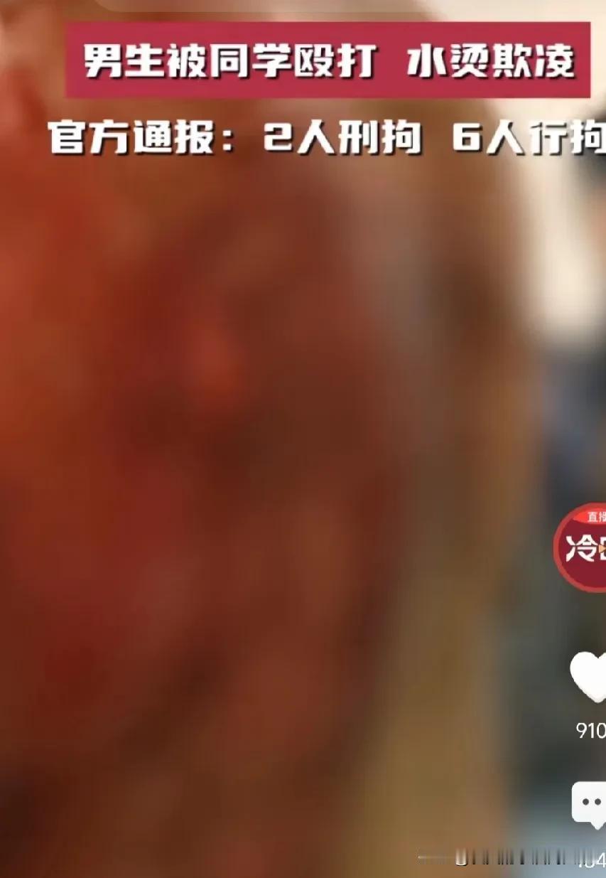 泼开水的孩子真的应该千刀万剐。看这身上烫的，全都破皮了，都是烫伤，这得多疼啊！
