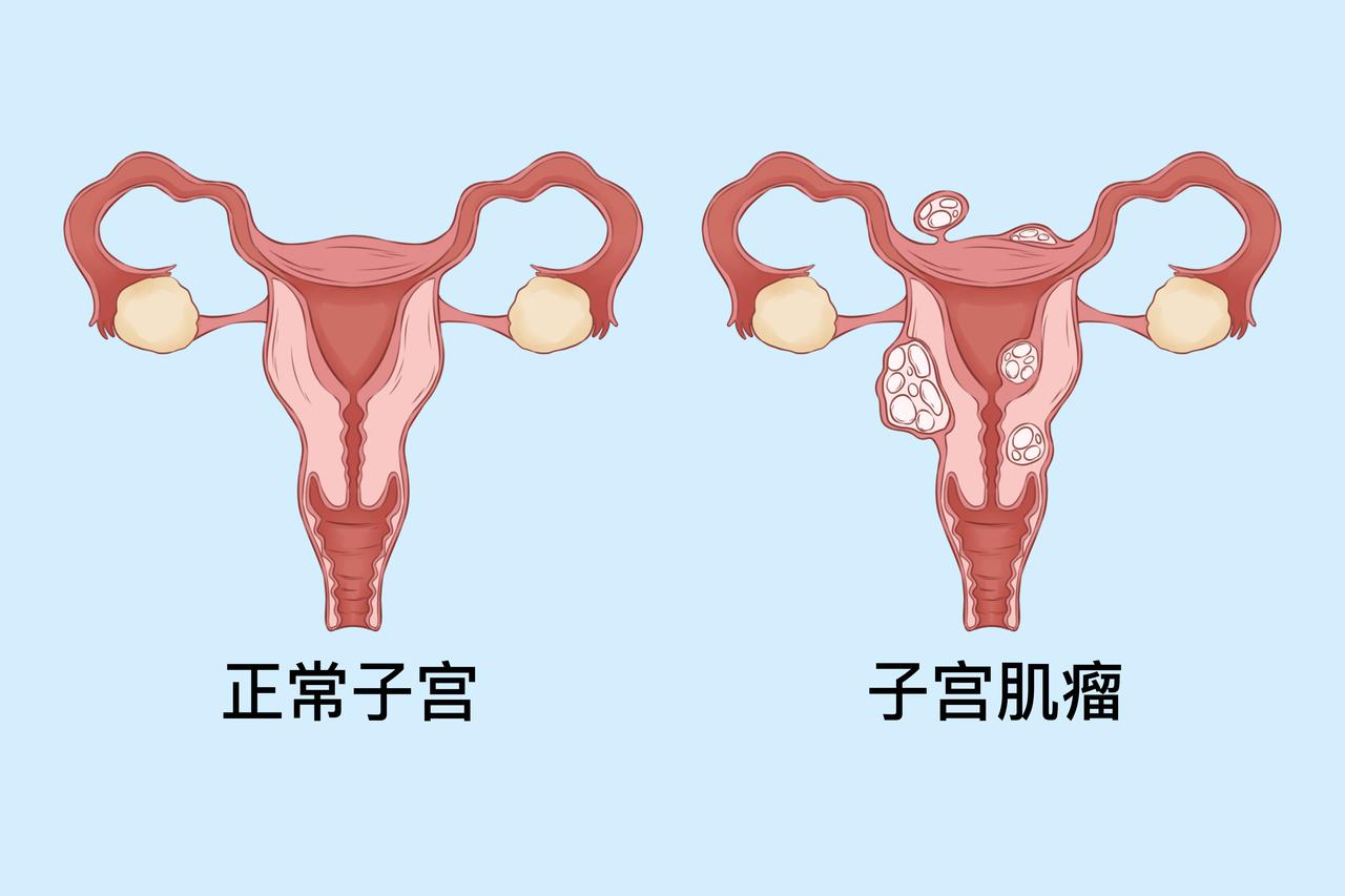 自从被诊断出子宫肌瘤后，我每天都很焦虑，睡觉也睡不好，每次复查，子宫肌瘤都在变大