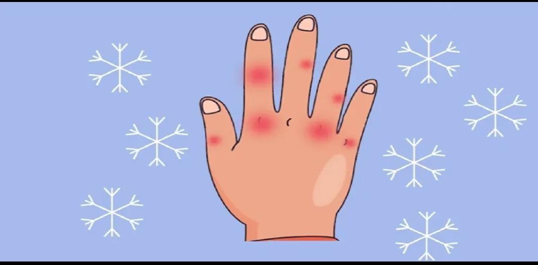 我肿胀瘙痒的手冻终于治愈了，我手冻有十年了，肿胀瘙痒起来，简直要命。为了治好它，