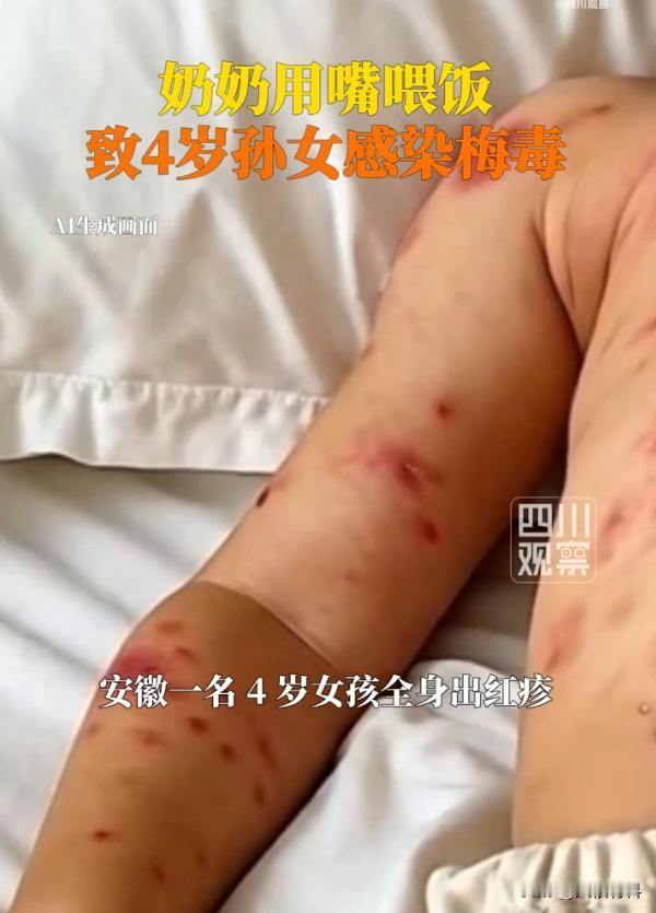“一言难尽！”近日，安徽一老人用嘴给4岁孙女喂饭，随后女孩全身出现红疹子，不痛也