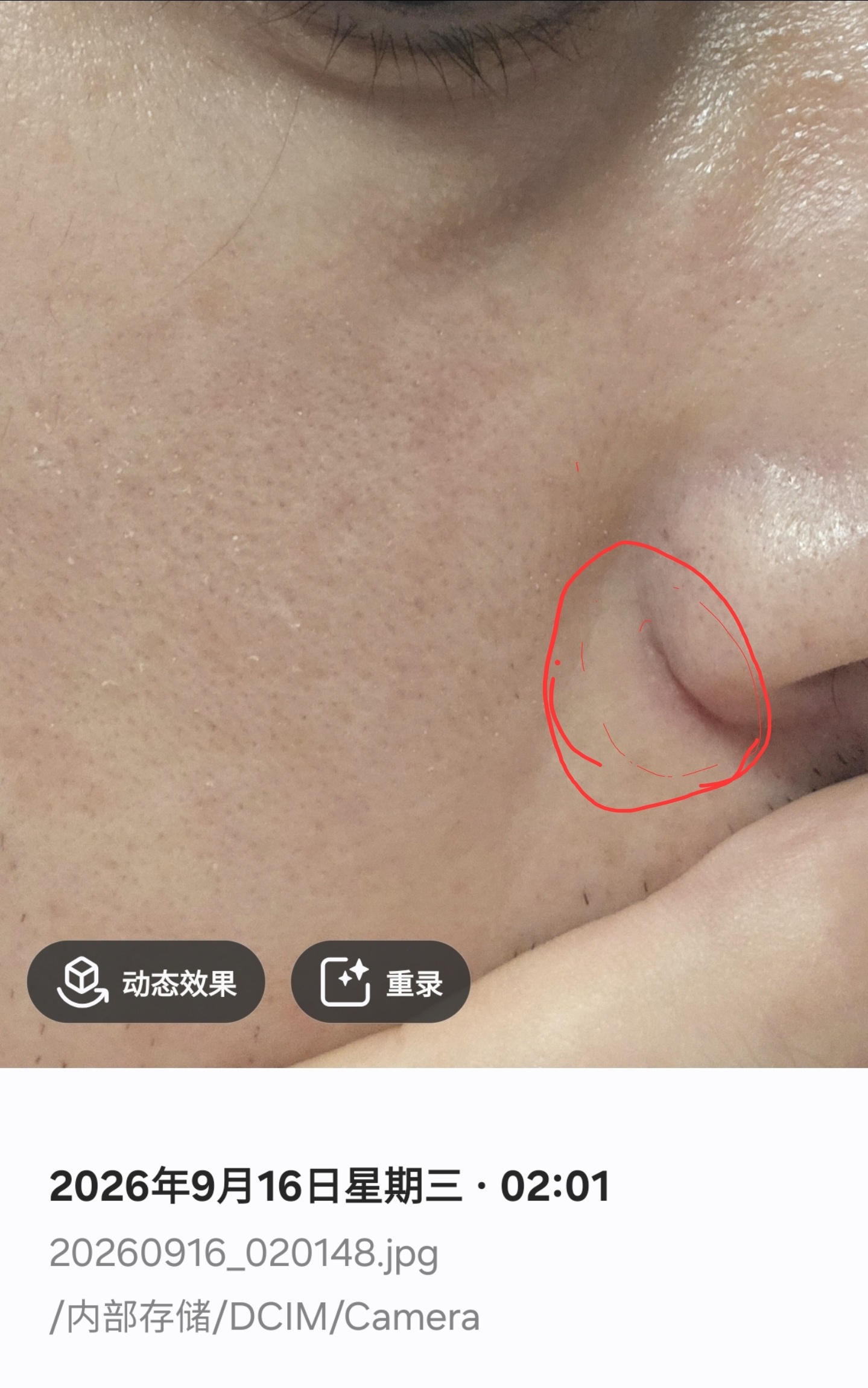 反馈贴：小脓疱不到一天就消失不见了这真是没想到，毕竟三角区，尽量不挤现在是只要是