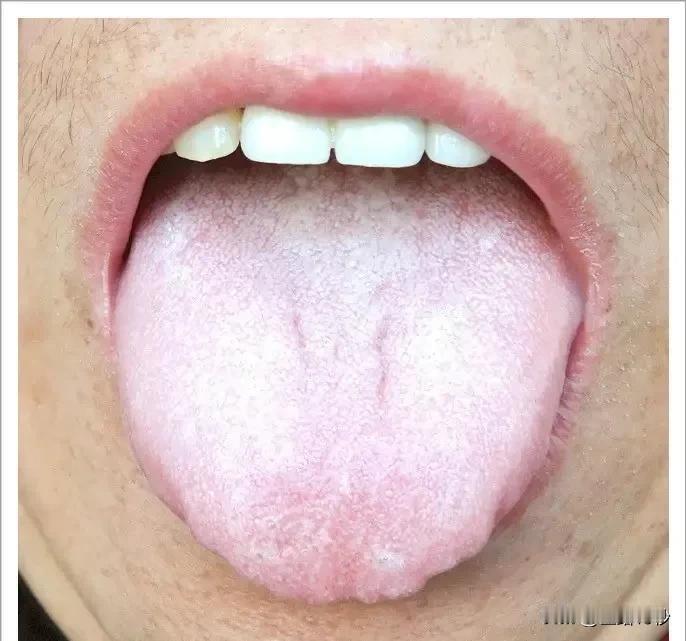 中医解析：舌苔颜色与厚薄揭示病情玄机

随着中医的不断发展，舌苔观察作为中医诊断