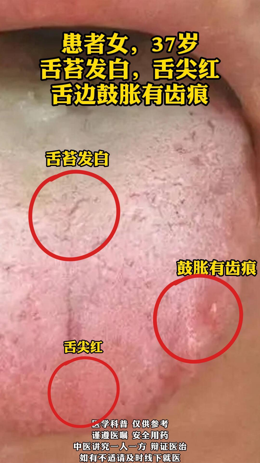 患者女，37岁
舌苔发白，舌尖红，舌边鼓胀有齿痕 
患者舌苔发白，这通常表明体内有寒邪或湿邪，或者存在气血不足的情况。舌苔发白是阳气不足，寒邪内生的表现，反映了患者可能存在脾胃虚寒，运化水湿能力下降，导致湿气滞留。
舌尖红，则提示心火上炎，可能与情志失调、饮食辛辣等因素有关，也可能与阴虚火旺有关。舌尖红还可能表示患者有热邪内蕴，尤其是心火旺盛。
舌边鼓胀有齿痕，多是由于脾虚湿盛，舌体胖大，受牙齿挤压而形成。齿痕舌是脾气虚弱，水湿内停的表现，反映了患者可能存在脾失健运，水湿内蕴的情况。 
结合舌苔表现，患者可