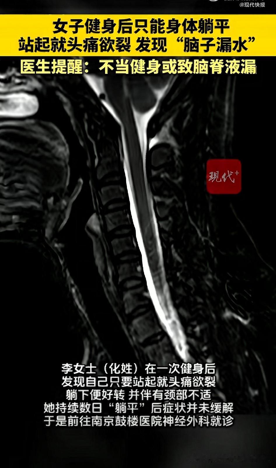 南京一位李女士健身过后，落下怪毛病：
躺着啥事没有，一站起身就头疼到扛不住，脖子