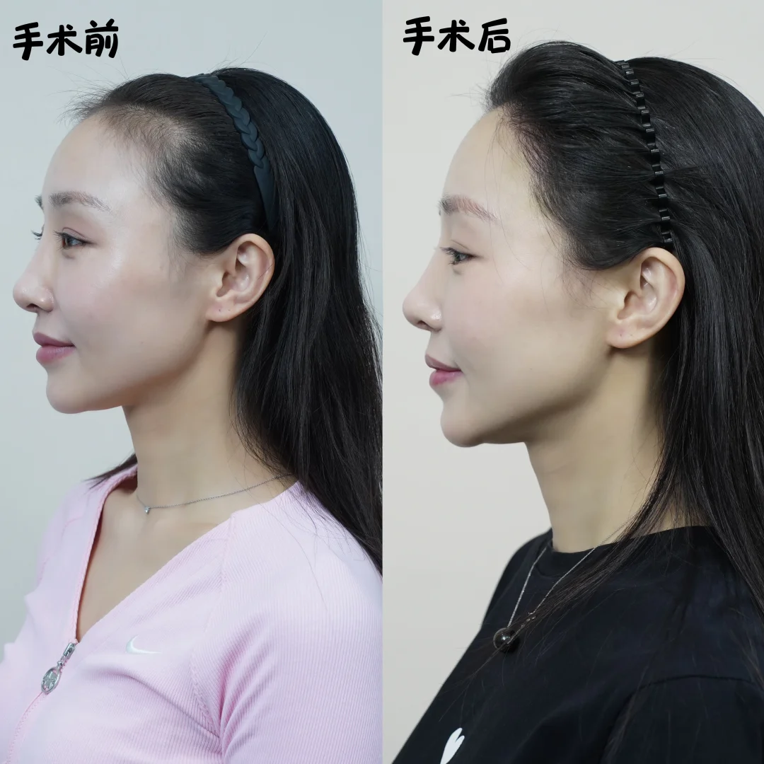 植发一个月真实记录｜心态崩完又自愈