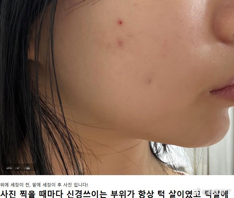 韩国双下巴抽脂+埋线案例，没有做下巴肌肉捆绑这个