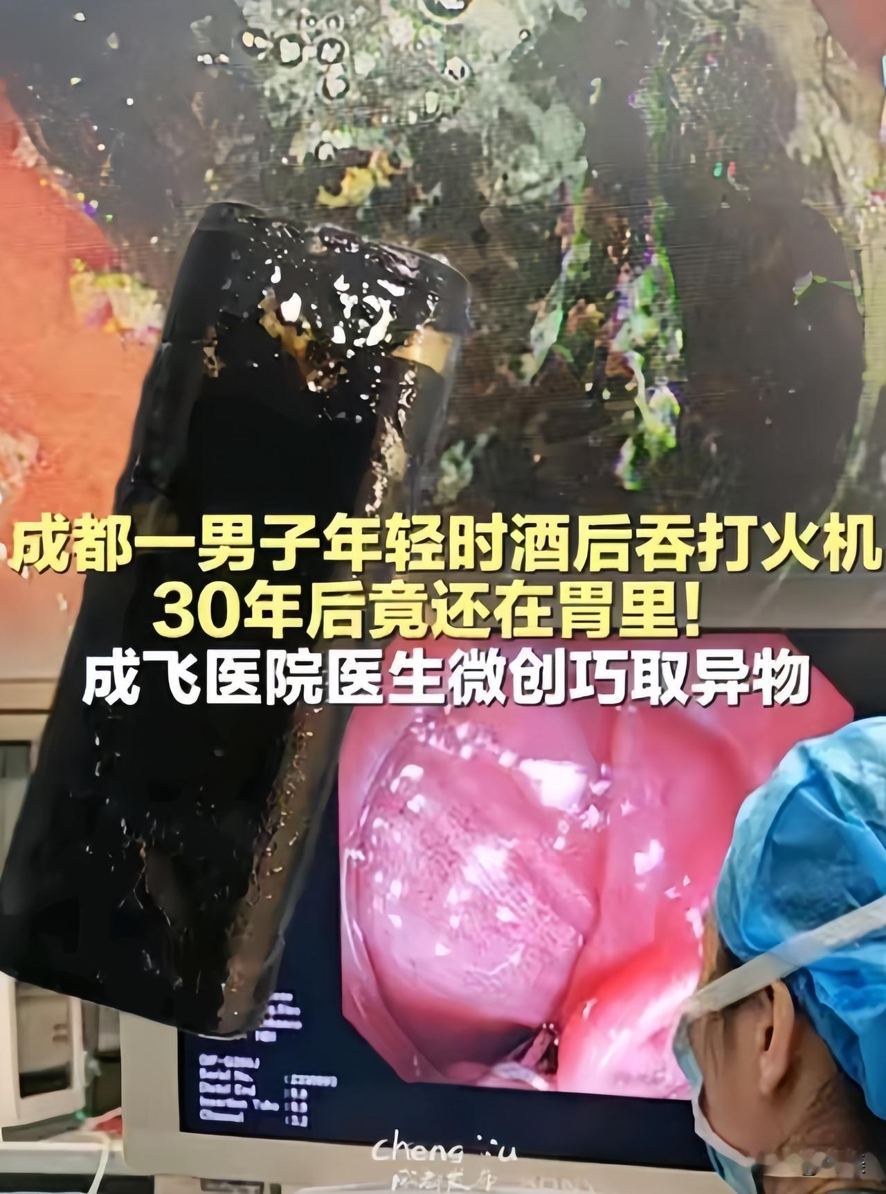 安全套立大功！成都67岁老邓肚子不舒服，去医院一查，胃里有个黑色异物。...
