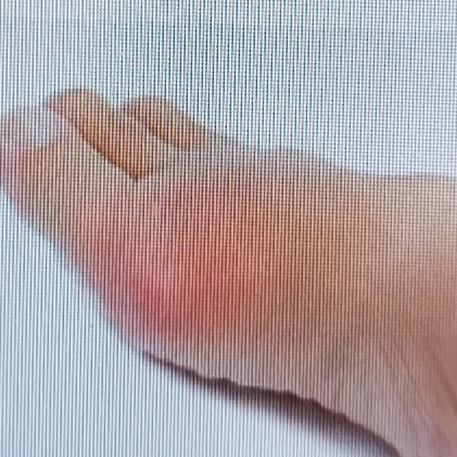 中老年人下肢水肿可愁人了，不过有几个简易办法能解决。
要是非疾病因素导致的水肿，