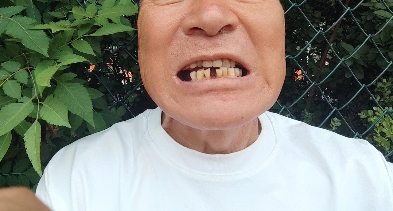 这个牙，我应该怎么办好！
门牙下边的三个小牙都晃动了，尤其中间这个晃动厉害，但好