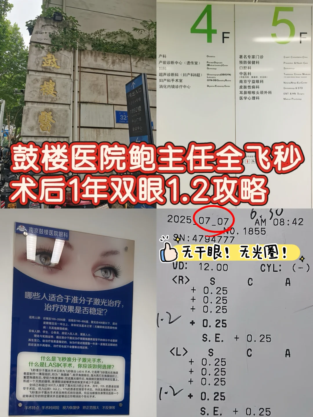 南京鼓楼医院鲍主任全飞秒近视手术1年后续