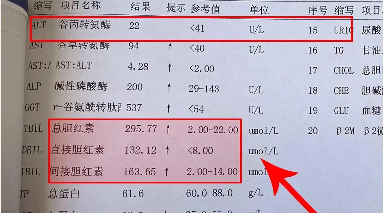 肝硬化转氨酶升高不可怕，这个指标升高才危险，当心肝衰竭 最近接诊了不少...