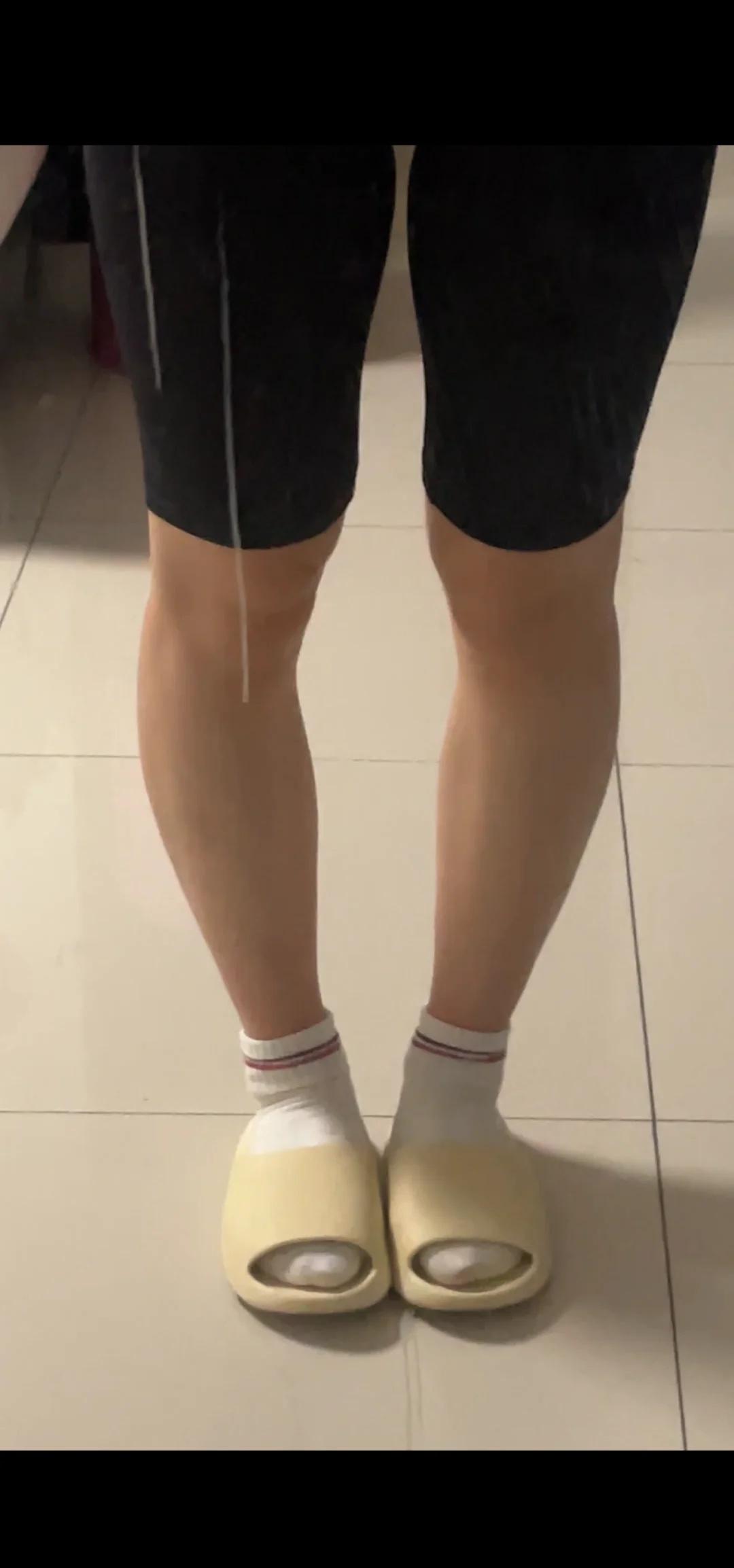 这样的腿算是直腿吗
从以前的小腿外翻膝盖内扣到现在这样的腿
姐妹们帮我看看这样是