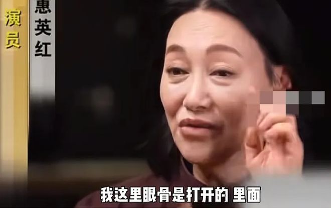 惠英红在综艺节目中坦然分享自己的整容经历与演艺生涯中的伤痕累累，引发网友热议。她