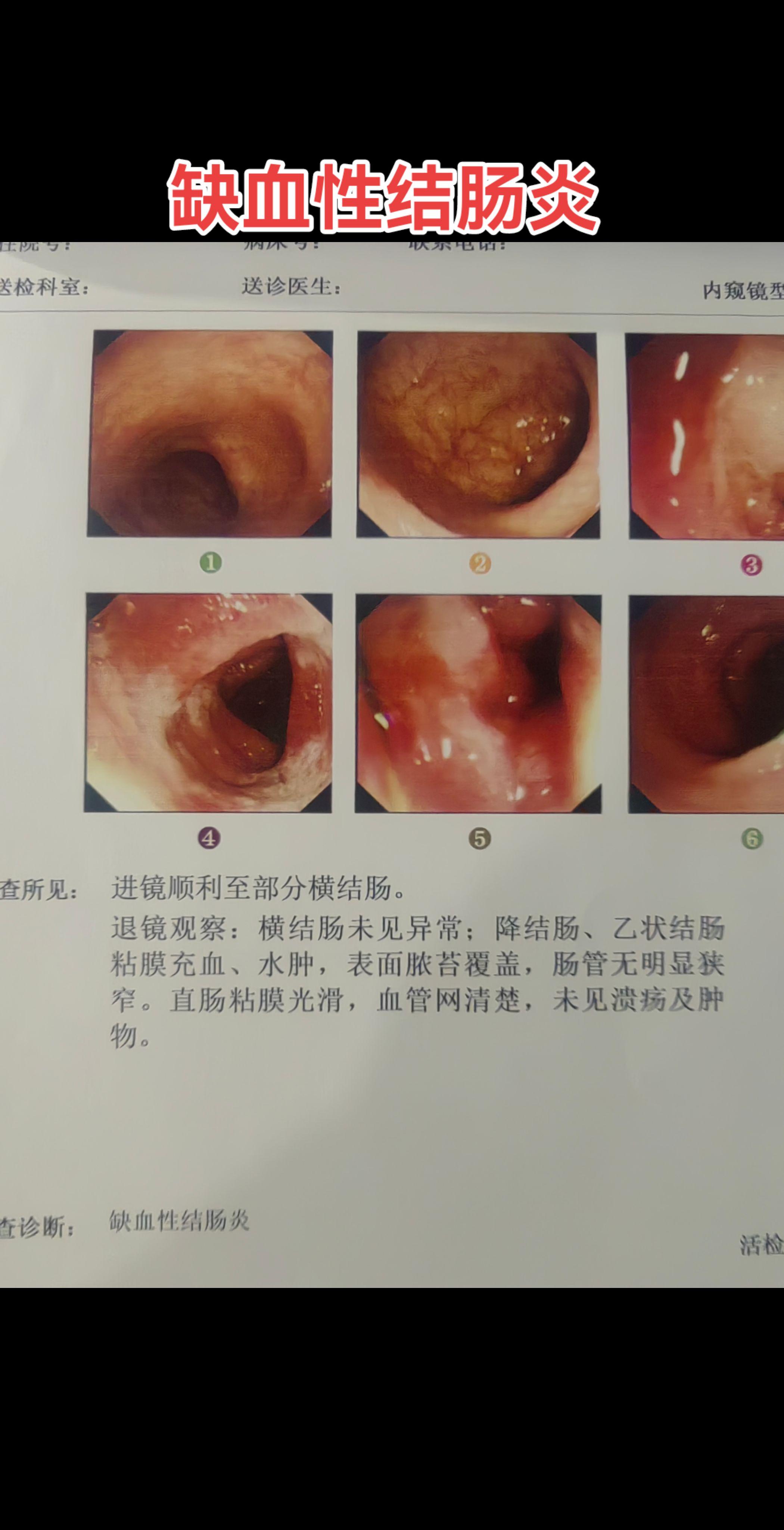 缺血性结肠炎。患者老年人，有冠心病史，症状为恶心呕吐腹痛腹泻，较剧烈！...