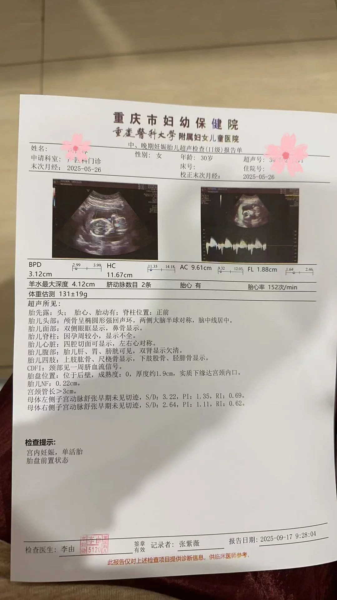 做NT时显示鼻骨欠清的不要担心，16W就正常了