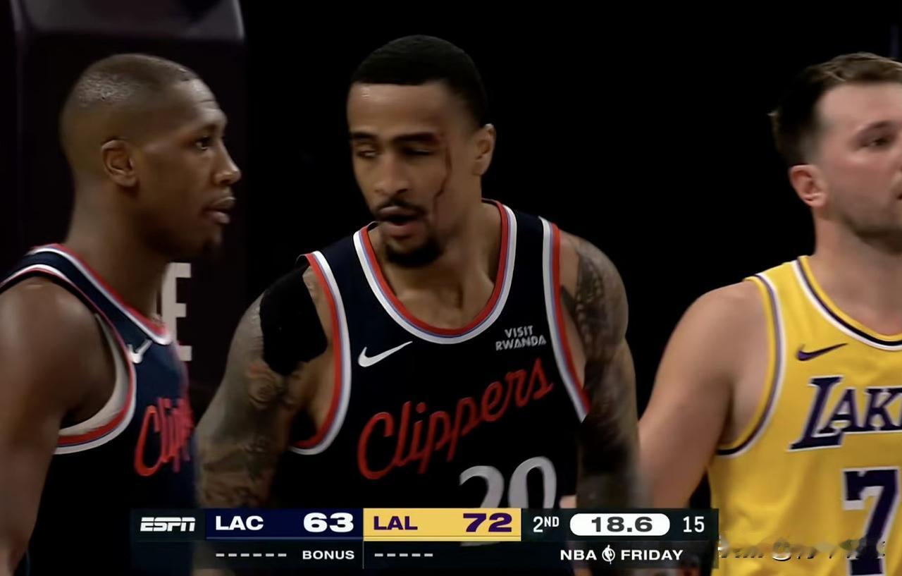 危险！科林斯血洒当场！

今天湖人主场对阵快船的比赛，第二节最后21.3秒，马瑟