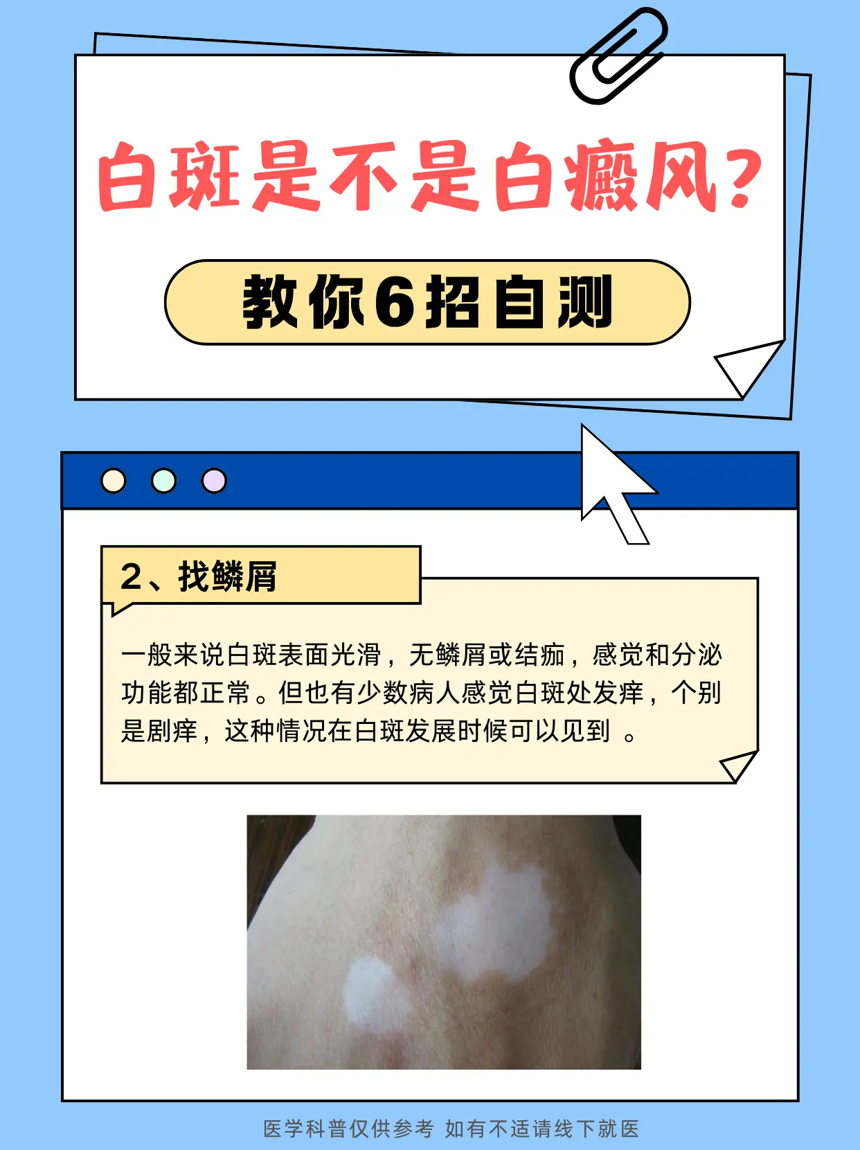 教你6招 自测白癜风