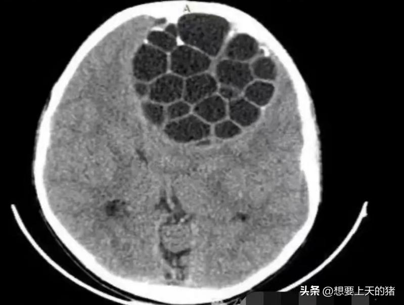 脑囊包虫病，俗称“脑子有个泡”。
不知道得有多大的泡，才能搞出这么大的动静！
把