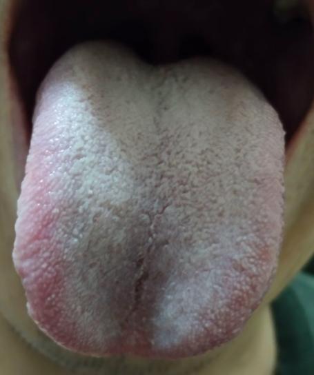 舌苔白的厉害，以为是阳气欲绝了！被吓得不轻啊！
 
主诉：浑身乏力，头晕乏力，而