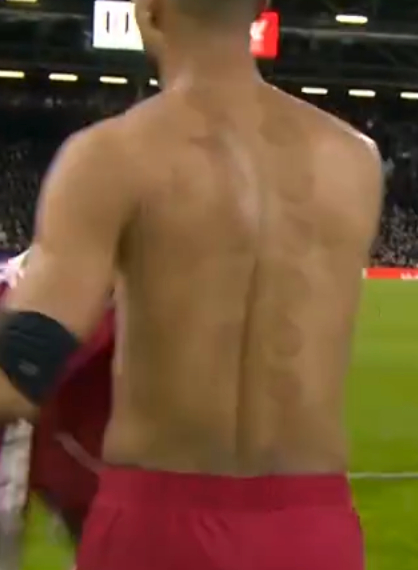 加克波应该没少拔罐还得是中国的老中医利物浦 成都