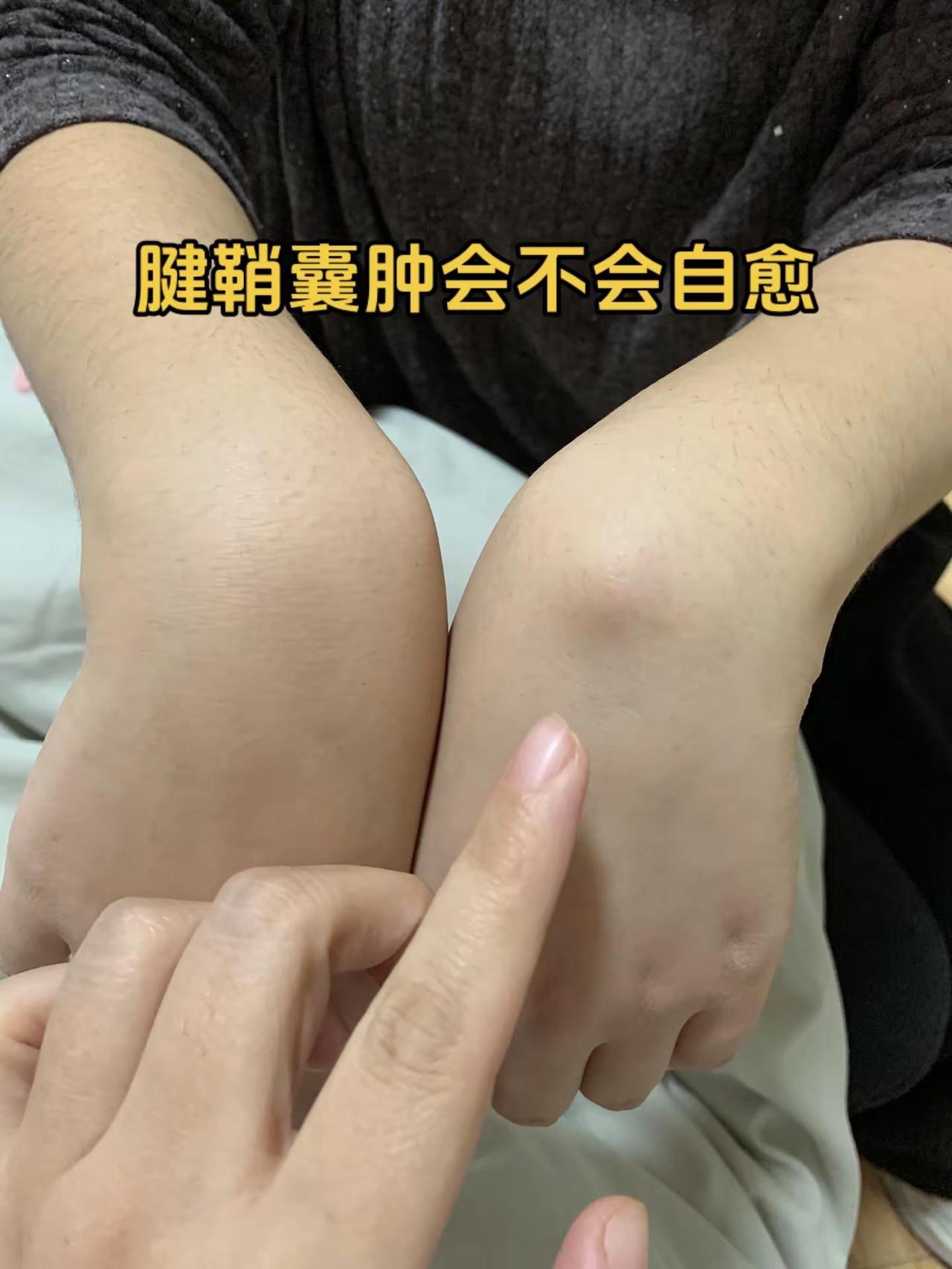 一场大雨后莫名的长了这个，带孩子去医院看，医生按了一下没按动，就建议用针管把里面