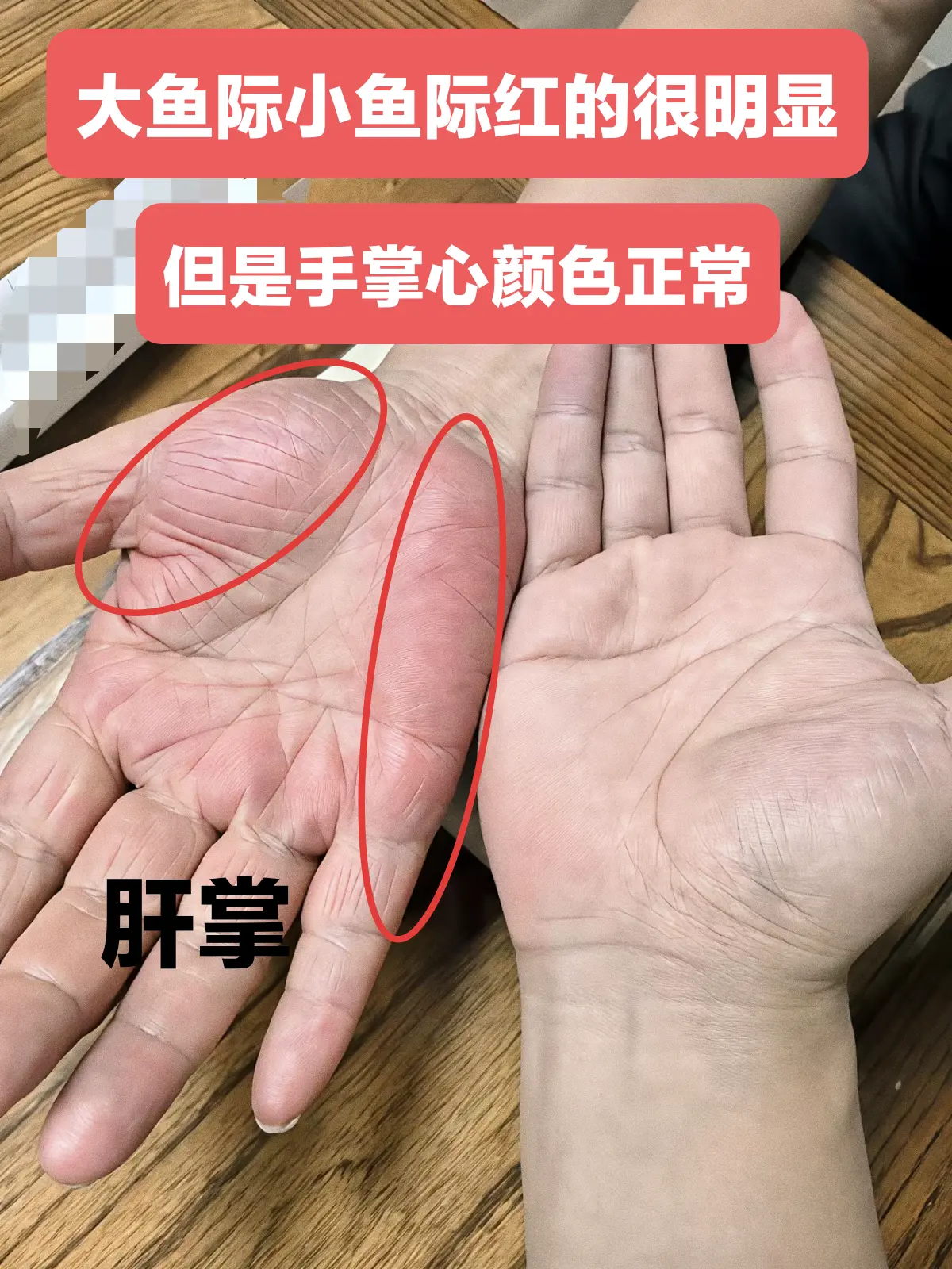 你能分清什么是肝掌了吗？ 注：肝掌是肝病患者的常见表现之一，但并非出现...